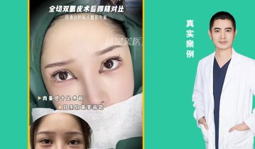 全切双眼皮术后即可对比