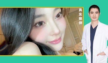 黄金媚眼重睑术效果【2】