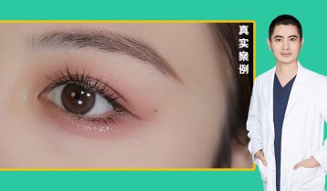 张书明医生-眼综合双眼皮效果
